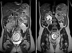 MRI: venous malformation