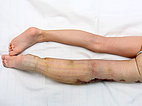 Minor local thrombophlebitis