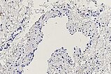 Ki67-staining – Combined venolymphatic malformation