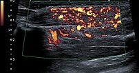 Power Doppler imaging – Subcutaneous infantile hemangioma