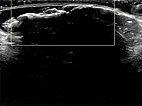 Color-coded duplex sonography: no perfusion detectable