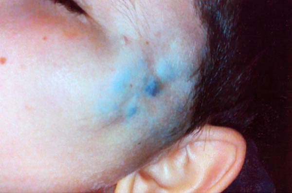 9-year-old boy with soft, bluish swelling