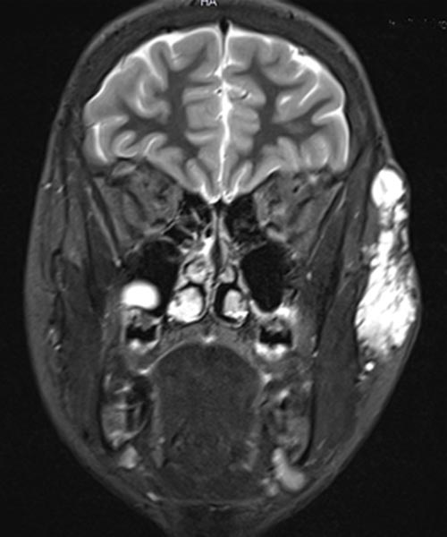 MRI of the face