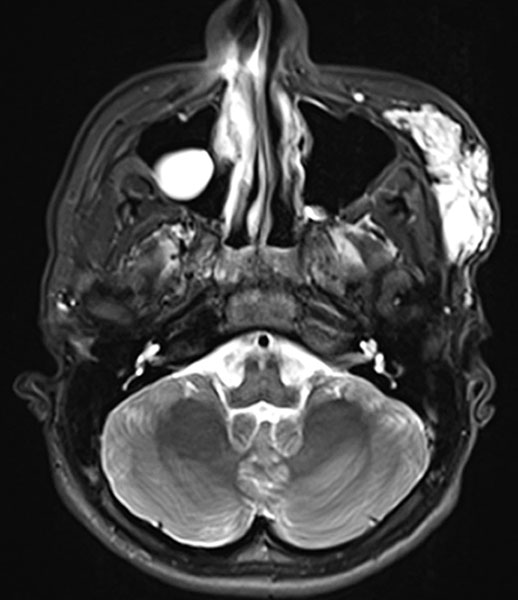 MRI: venous malformation on lateral face