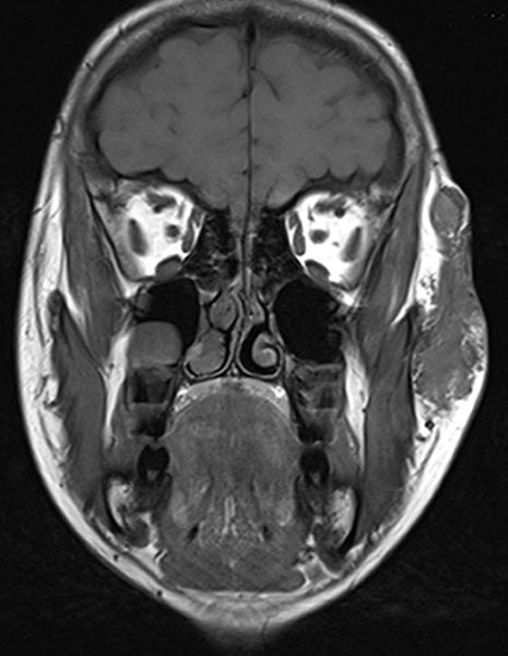 MRI:venous malformation on lateral face
