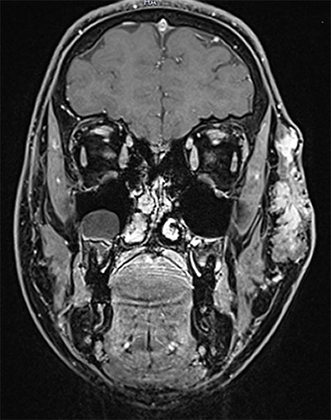 MRI: venous malformation on lateral face