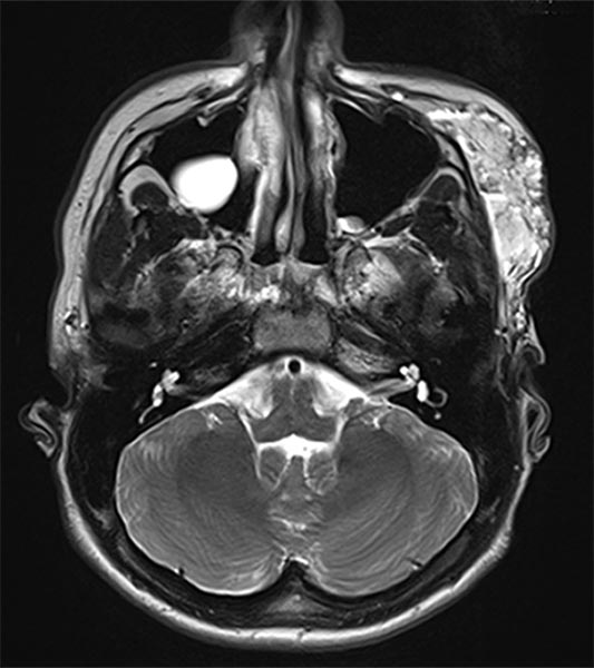 MRI: venous malformation of the face