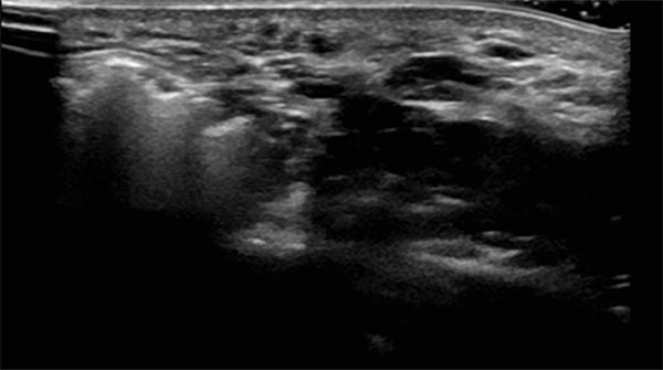 Sonography during sclerotherapy treatment