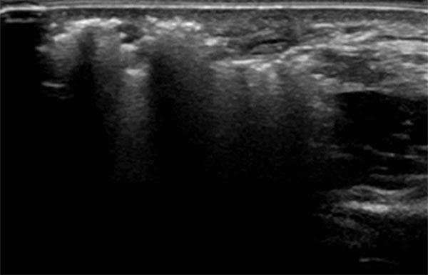 Sonography during sclerotherapy treatment