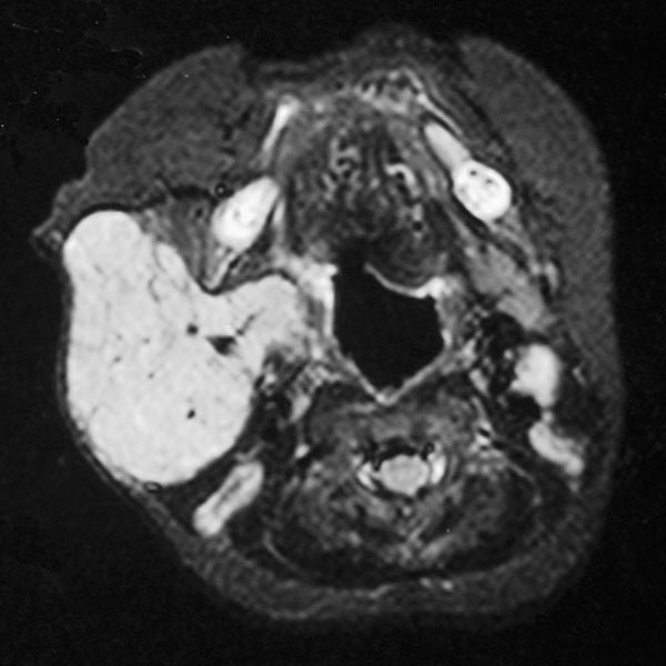 MRI: subcutaneously located tumor 