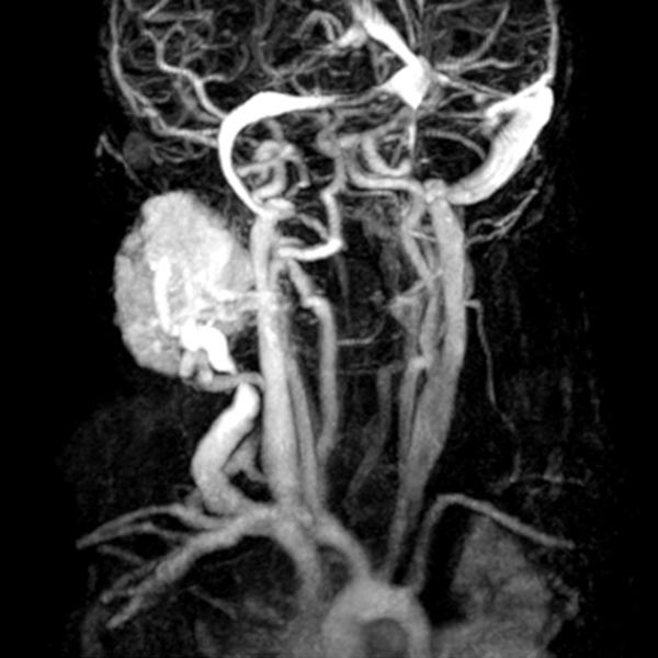 MR angiography: intense enhancement of the infantile hemangioma