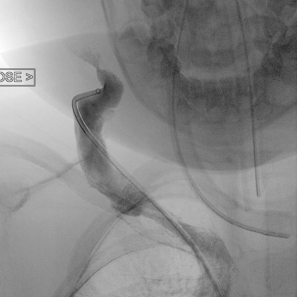 Stenosis of the venous outflow