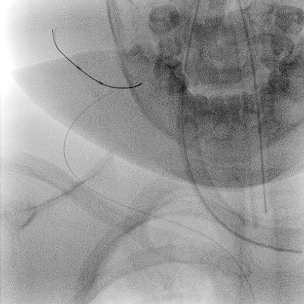 [Translate to English:] Stenosis: venous outflow 