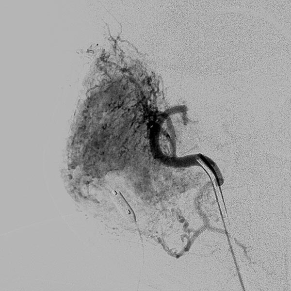 DSA: infantile hemangioma