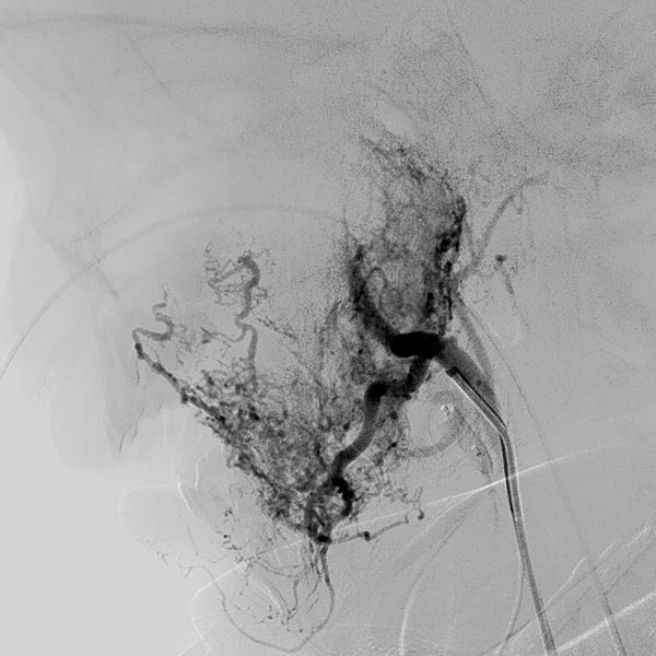 DSA: blocking the venous outflow