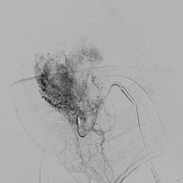 DSA: catheterization of the remaining arterial feeder