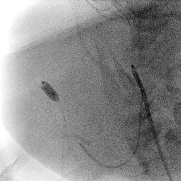 DSA: venous outflow