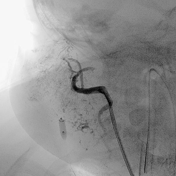 DSA: the infantile hemangioma is not perfused anymore