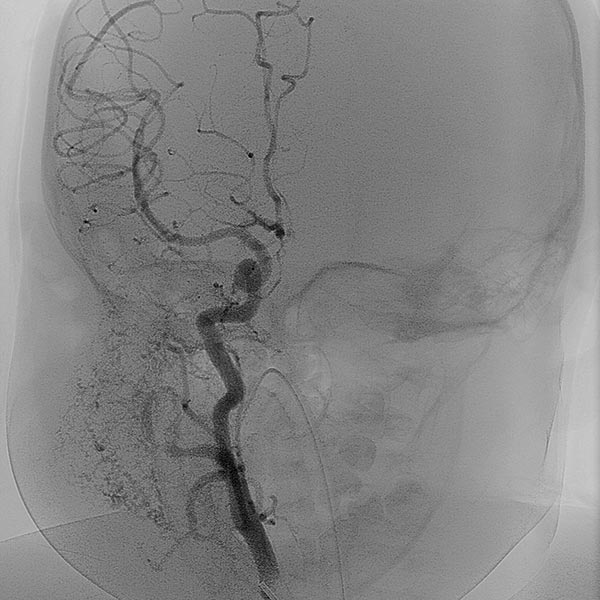 DSA: displays a virtually completely devascularized infantile hemangioma