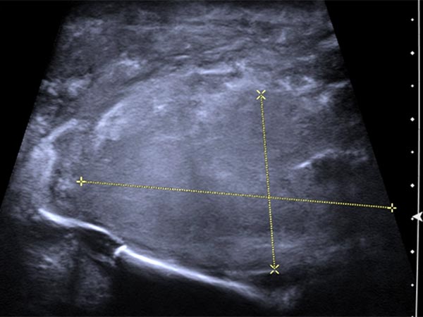 Sonography – main subcutaneous extent of the tumor