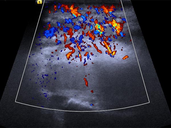 Color-coded duplex sonography – tumor shows marked perfusion