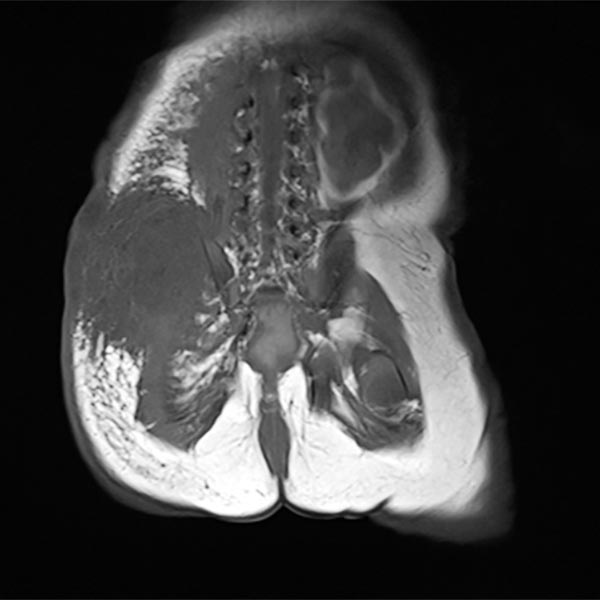 MRI – tumor to be hypointense