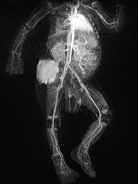 MR angiography – Kaposiform hemangioendothelioma