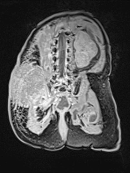 MRI – tumor accumulates contrast strongly