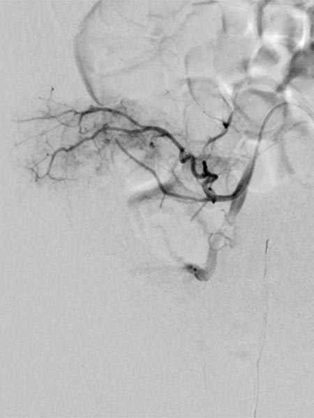 DSA – embolization