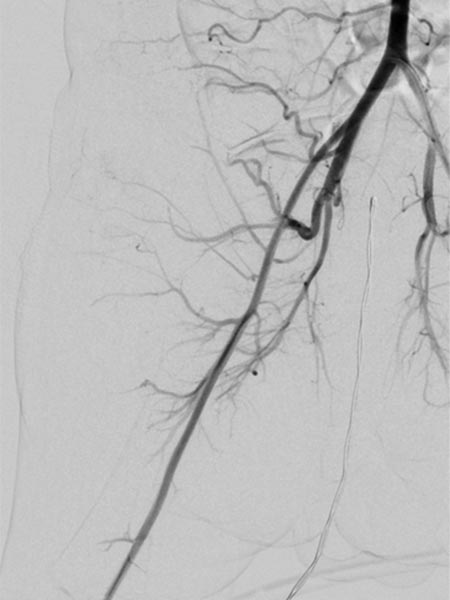 Control angiography – tumor has stopped
