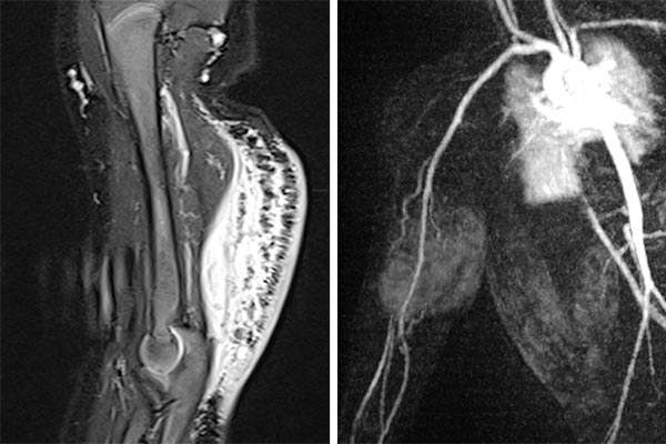 MRI – tumor at the dorsal upper arm