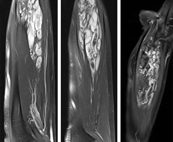 MRI: Venous malformation