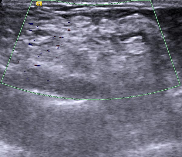 Duplex sonography after multiple sclerotherapy