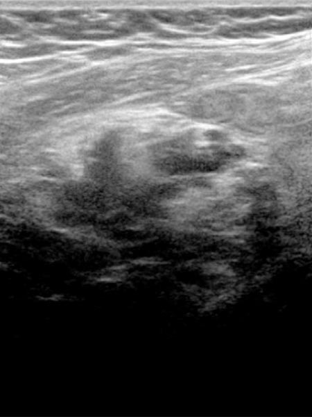 Sonography: venous malformation