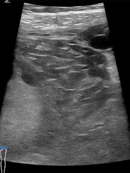 Sonography: venous malformation