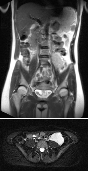 MRI: venous malformation