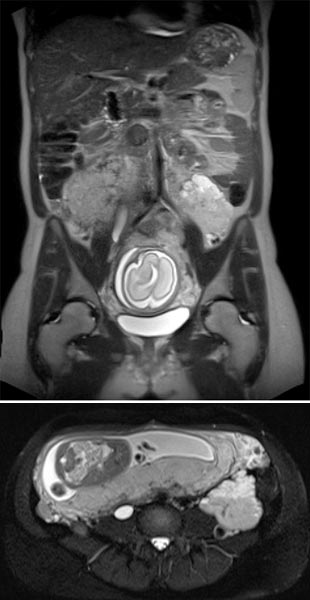 MRI: venous malformation