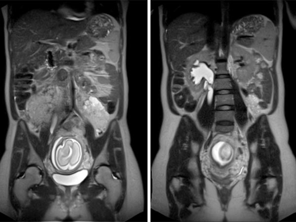 MRI: venous malformation