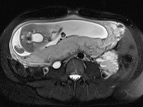 MRI: venous malformation