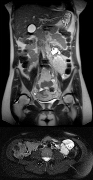 MRI: venous malformation