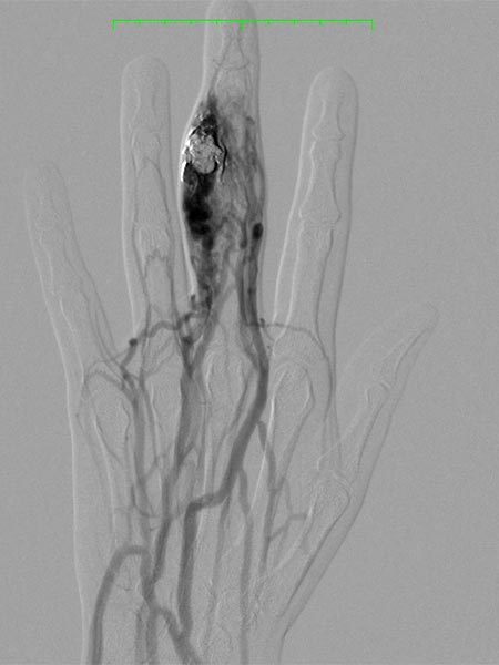 DSA: arteriovenous malformation