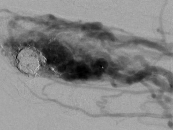 DSA: arteriovenous malformation