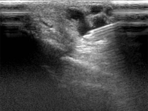 Sonography: puncture needle into the drainage vein
