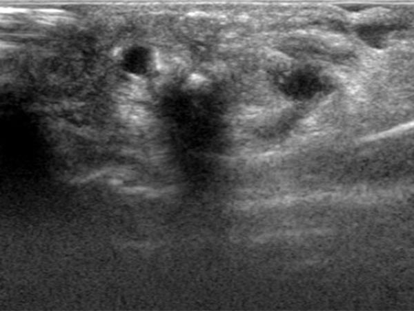 Embolization: arteriovenous malformation