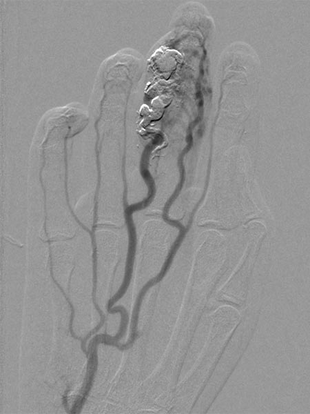 Embolization: arteriovenous malformation