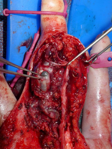 Intraoperative: microsurgical dissection of the middle finger