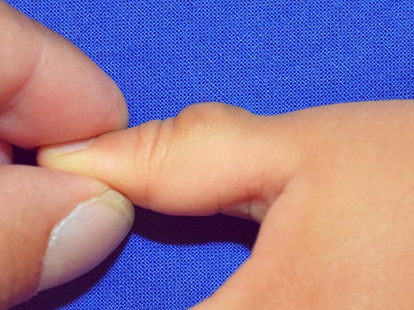 Venous malformation of the thumb