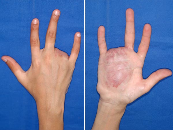 Arteriovenous malformation of the hand