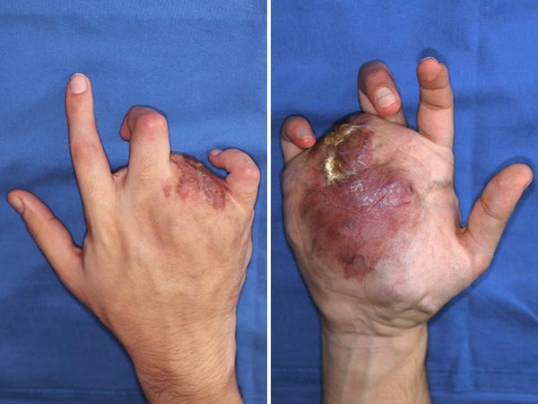 Arteriovenous malformation of the hand