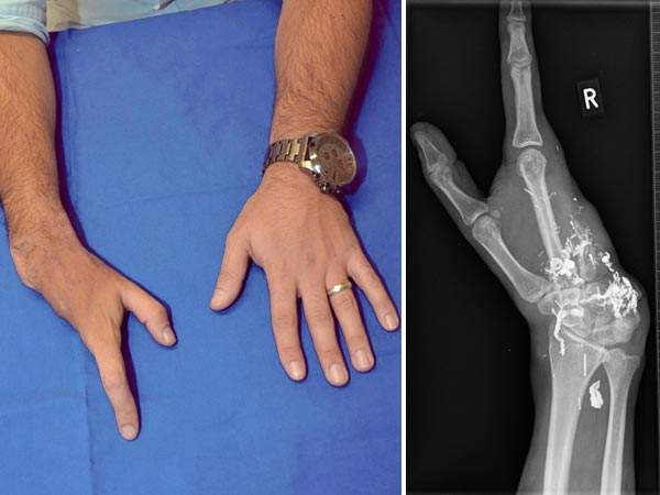 X-ray: arteriovenous malformation of the hand